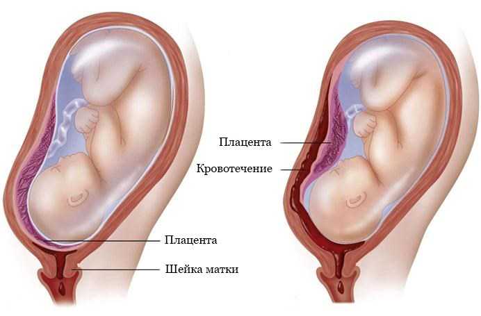 Низкая плацентация при беременности | уроки для мам
