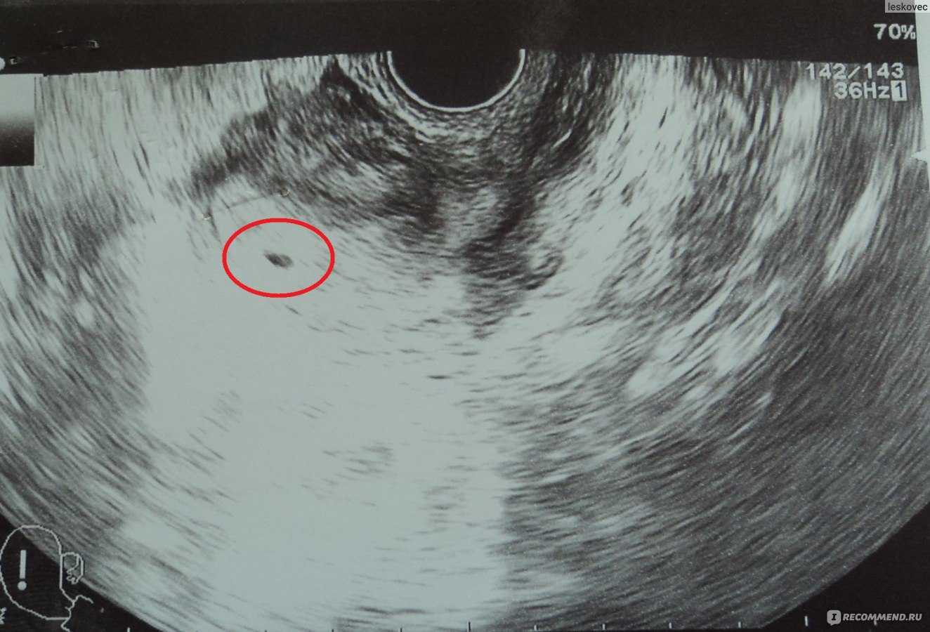 3 неделя беременности, признаки, ощущения, что происходит на третьей неделе после зачатия