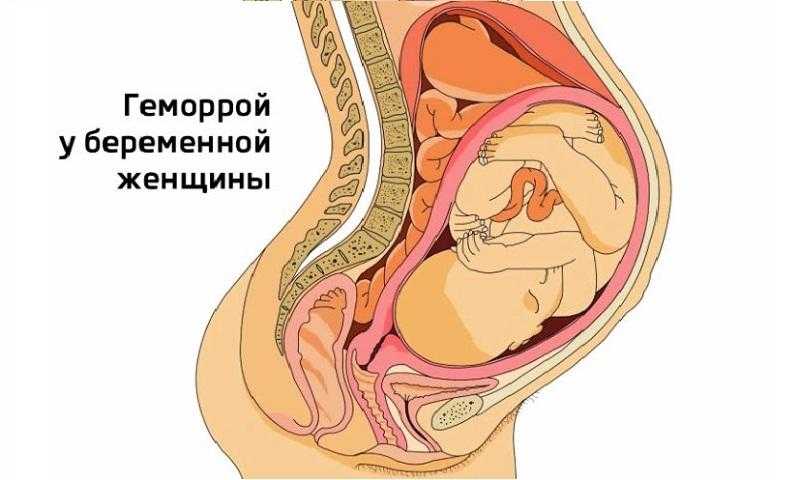 Как лечить геморрой у беременных. виды геморроя у беременных. упражнения для профилактики геморроя