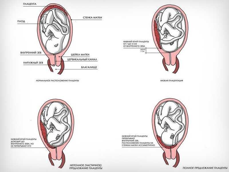 Низкое предлежание плаценты при беременности чем грозит