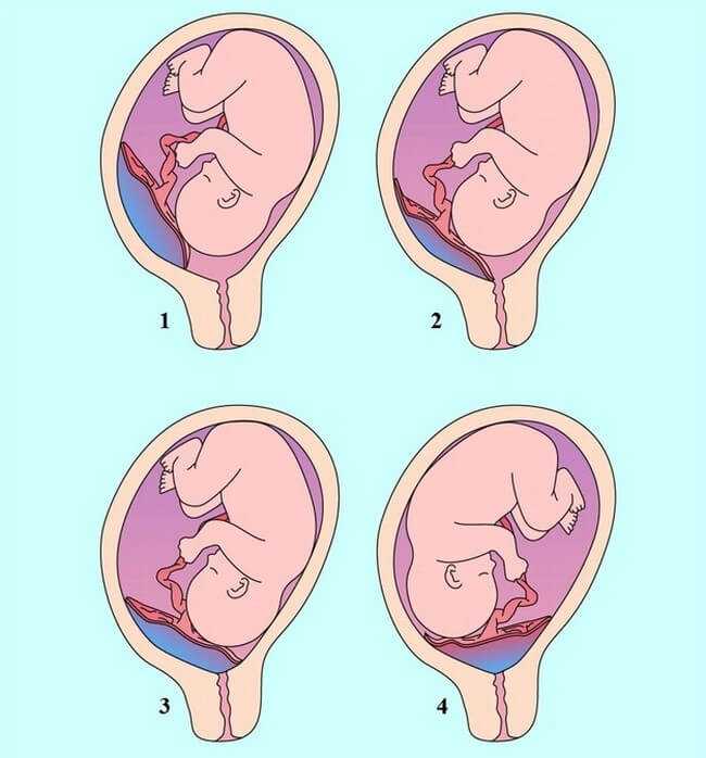 Низкая плацентация при беременности 20 недель: причины появления и связанные с ней риски