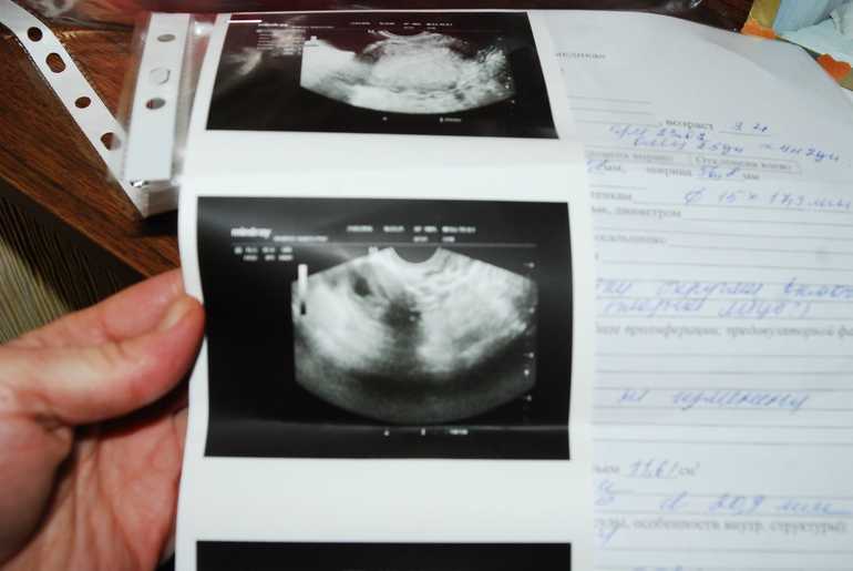 Первое узи при беременности: подготовка и результаты обследования
