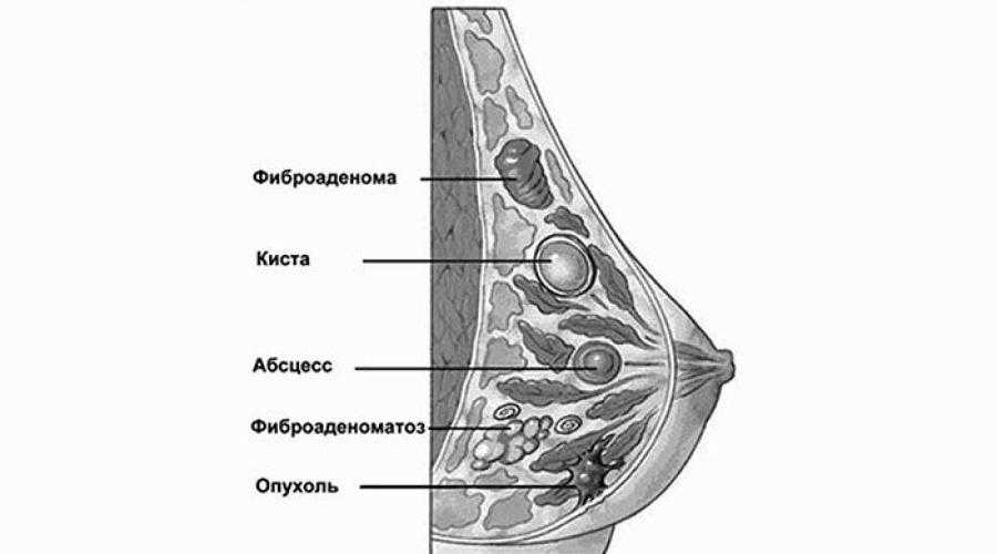 Фиброаденома Молочной Железы Симптомы Фото