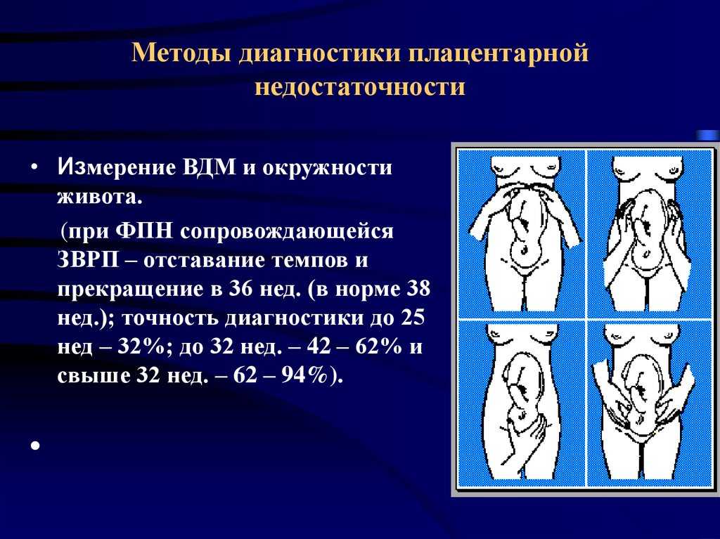 Плацентарное нарушение 1а. Фетоплацентарная недостаточность а1. Степени плацентарной недостаточности. Методы диагностики плацентарной недостаточности. ФПН 1а степени.