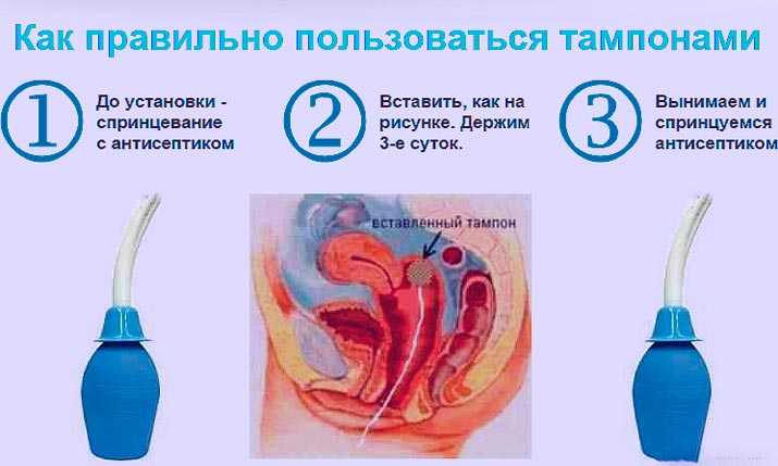 Всё о правильном использовании соды при беременности и грудном вскармливании: рецепты растворов для полосканий, ингаляций и других процедур