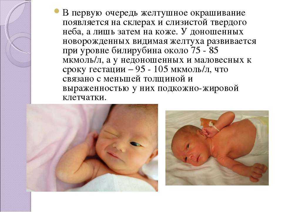 Желтуха новорожденных. диагностика, лечение, последствия и профилактика желтухи новорожденных