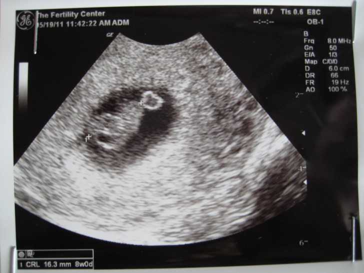 6 неделя беременности: размер плода, ощущения и фото узи