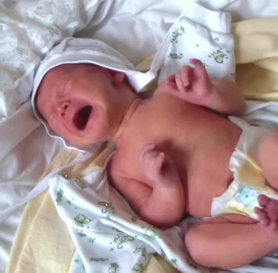 Опрелости у новорожденных на попе (11 фото): чем лечить грудничка, лечение при сильных опрелостях, как избавиться – лучшие методы