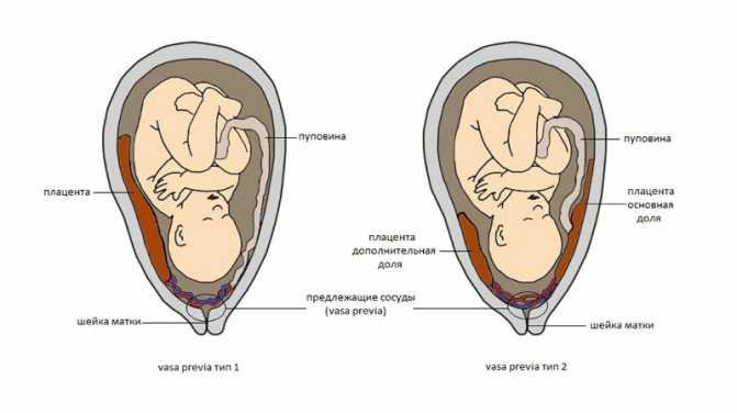 Что делать, если выявлена низкая плацентация при беременности