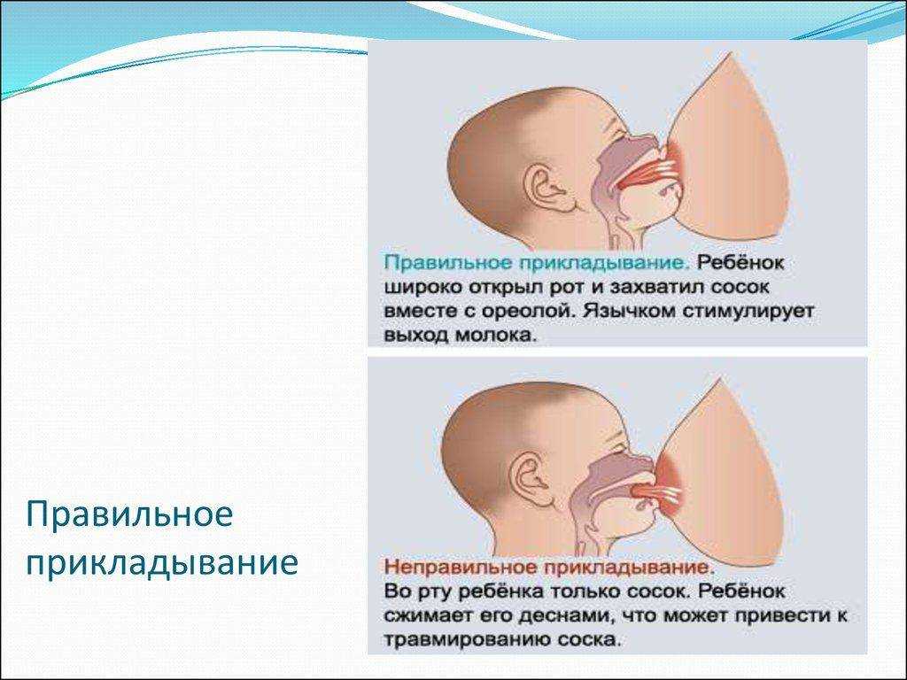 Лактостаз при грудном. Правильное прикладывание ребенка. Мастит при грудном вск. Правильное прикладывание при грудном вскармливании. Правильный захват груди.