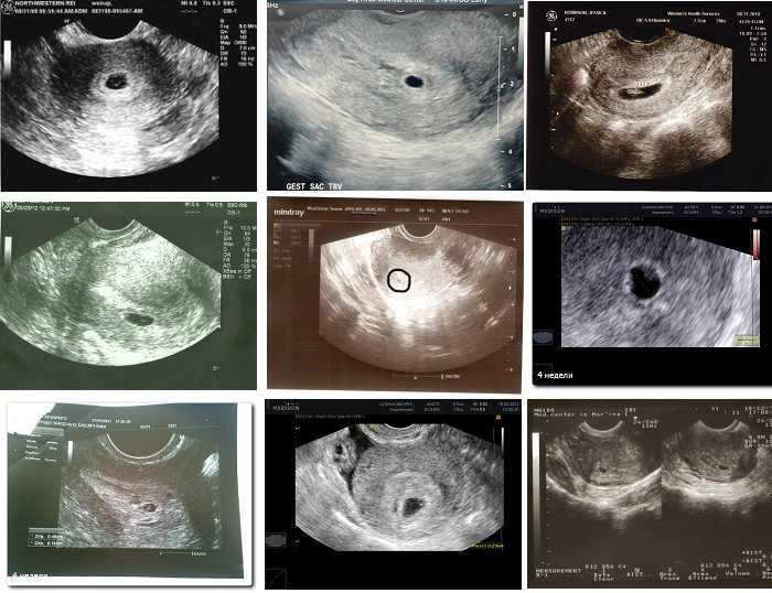 2 недели беременности: признаки, что происходит от зачатия, фото плода, узи