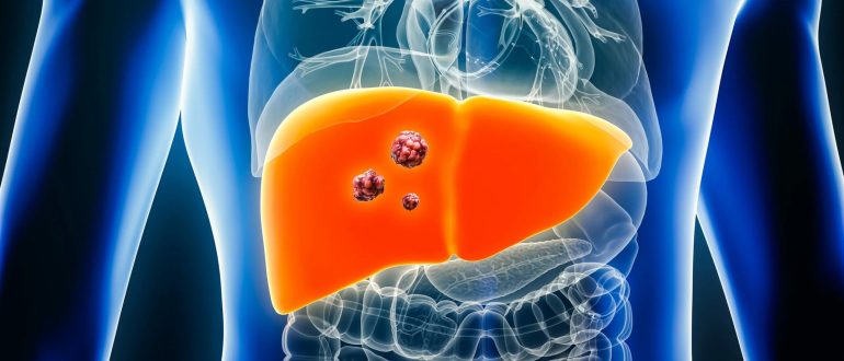 Рак печени 4 стадии и главные цели поддерживающей терапии