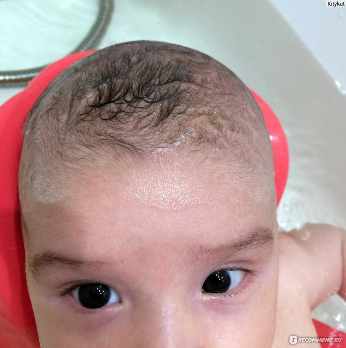 Себорейный дерматит у грудничка, новорожденных (34 фото): лечение волосистой части головы
