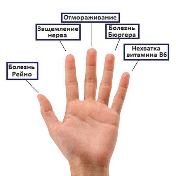 Немеют пальцы рук при беременности: причины онемения у беременных, лечение
