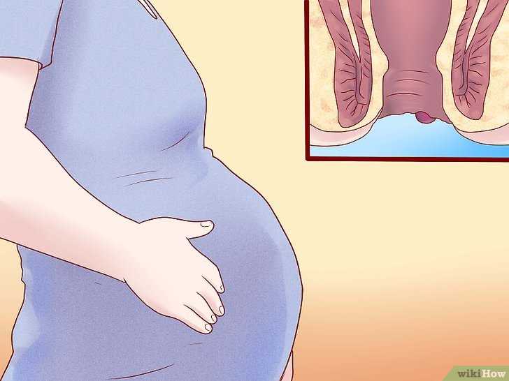 Мазь от геморроя при беременности: 10 лучших препаратов