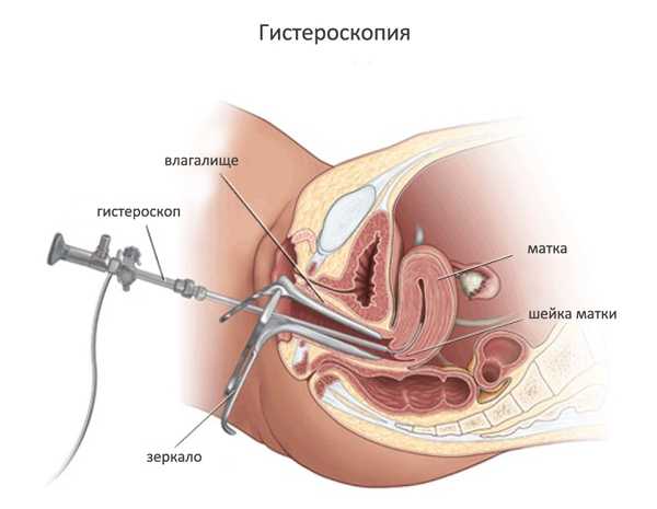 Гистероскопия матки: безопасна ли процедура для здоровья женщины и что она из себя представляет?