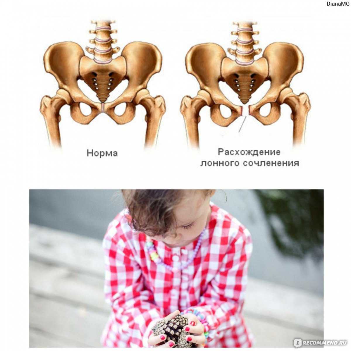 Симфизит (27 фото): симптомы при беременности и после родов, что это такое, расхождение костей таза у беременных, признаки и лечение