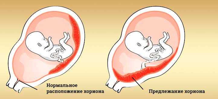 Отслойка плаценты на поздних сроках беременности | уроки для мам
