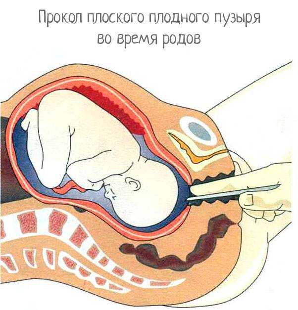 Легкие роды: упражнения для подготовки беременных к родоразрешению, гимнастика для облегчения процесса