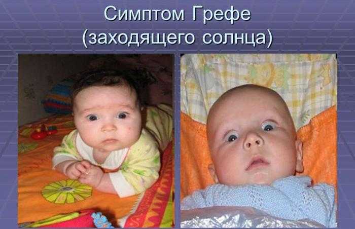 Почему новорождённый закатывает глаза - медицинский справочник medana-st.ru