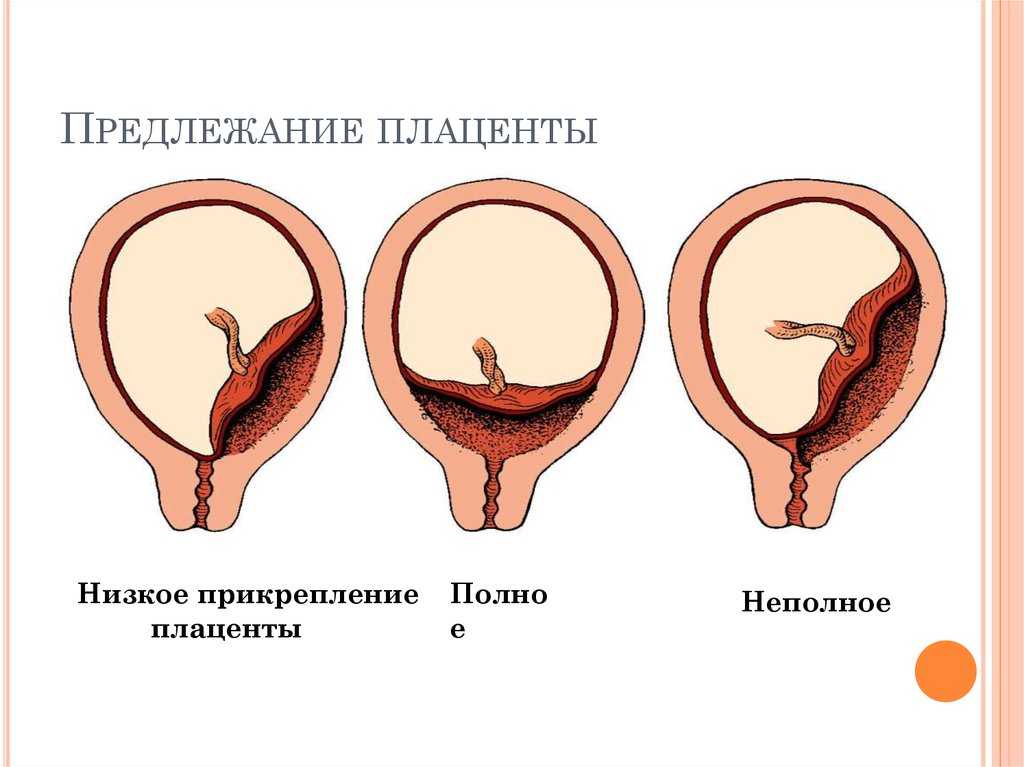 Низкое расположение плаценты при беременности, что делать? :: syl.ru