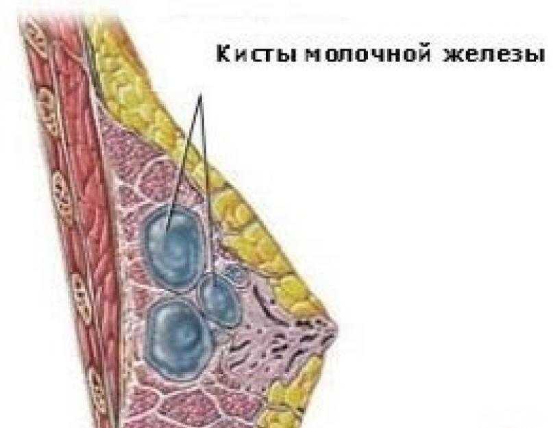 Уплотнение молочных желез. Субареолярная киста молочной железы. Уплотнение в молочной железе у женщин.