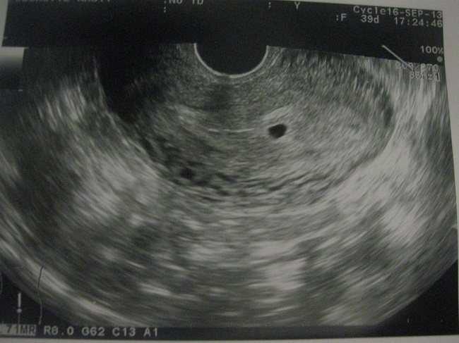 3 неделя беременности: фото плода, узи, признаки на 3 недели беременности