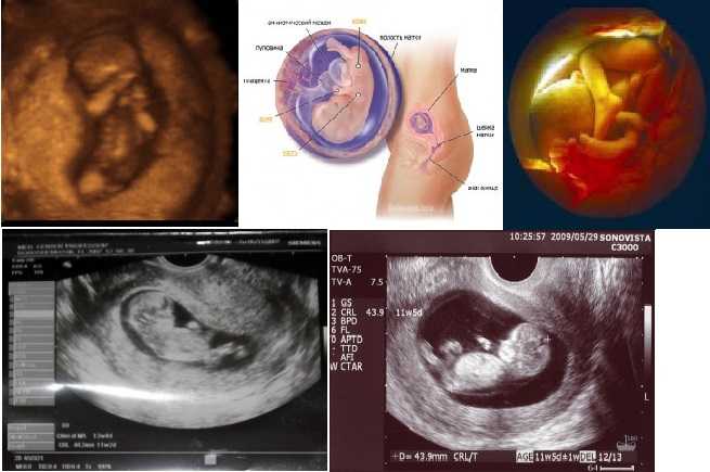 11 неделя беременности: ощущения, развитие плода, первое скрининговое узи