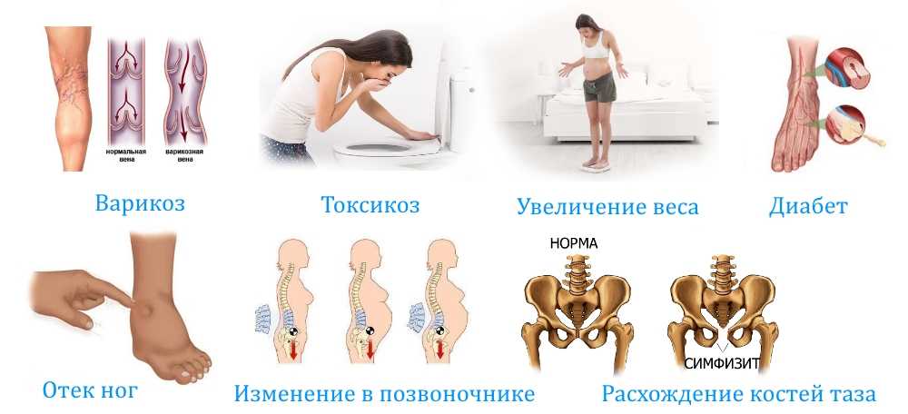 Боли в суставах при беременности: причины и лечение / mama66.ru