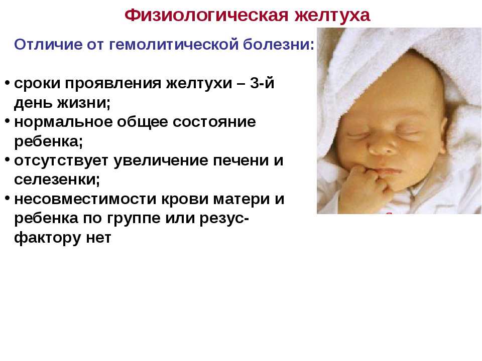 Желтуха у новорожденных: виды, причины и симптомы, лечение, последствия