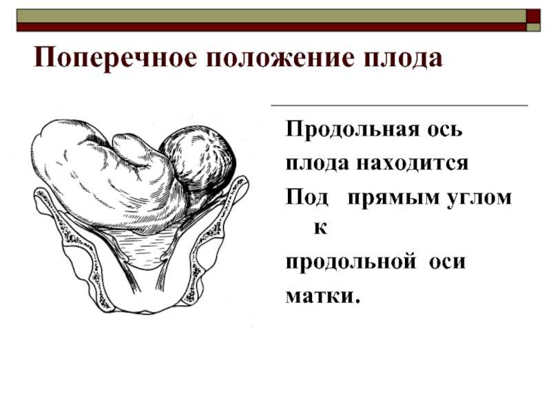 Продольное положение плода (20 фото): что это означает, головное продольное и тазовое предлежание при беременности