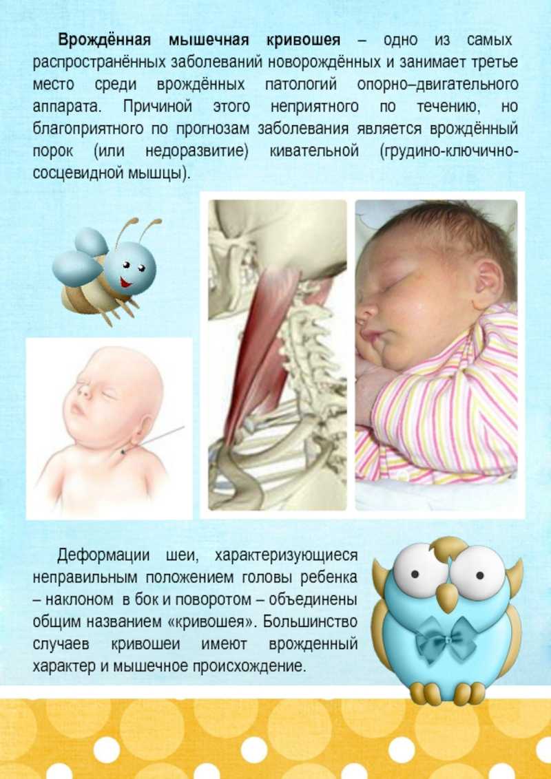 Кривошея у новорожденных детей: фото, симптомы, признаки, лечение грудничка