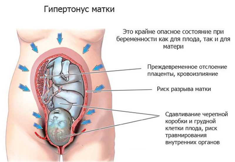 Тонус и гипертонус матки при беременности: симптомы и причины