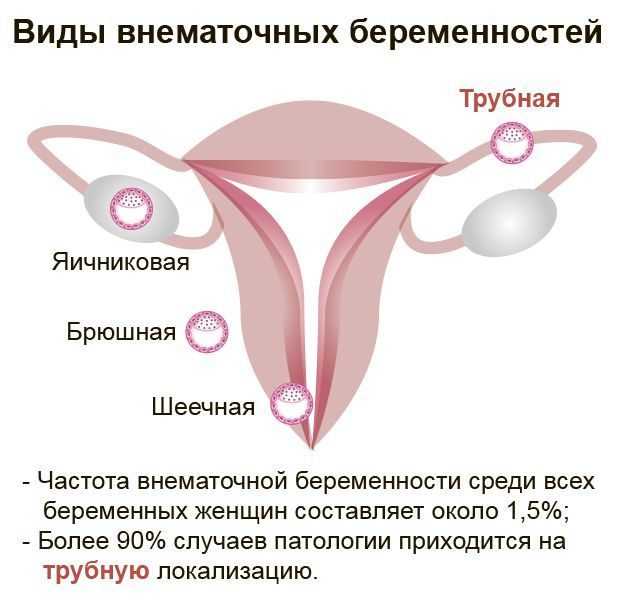Признаки внематочной беременности на раннем сроке