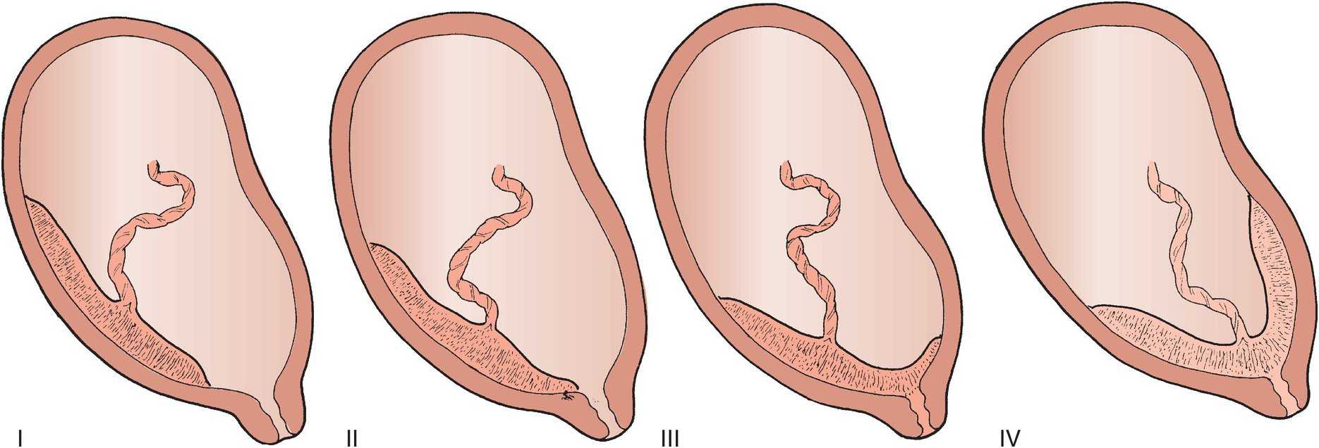Предлежание плаценты (36 фото): положение хориона при беременности, что такое неполное расположение и миграция