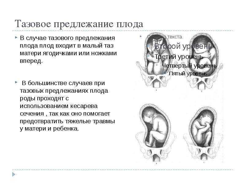 Поперечное положение плода (22 фото): поперечное предлежание при беременности, головное поперечное и косое со спинным положением ребенка, причины и упражнения