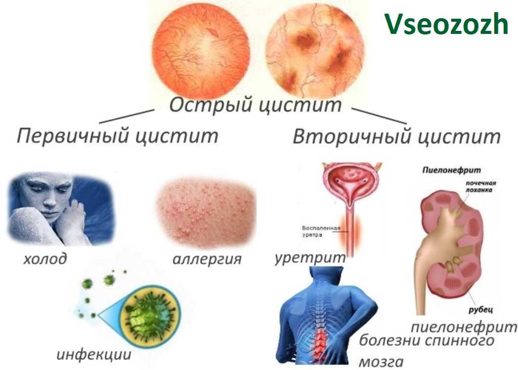 Цистит это простыми словами. Инфекция мочевой системы (острый цистит,. Первичные симптомы цистита. Первичный и вторичный цистит.