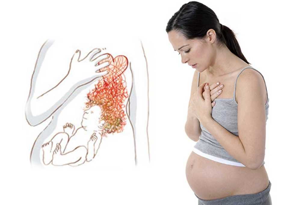 Изжога у беременных: как избавиться, лучшие средства и таблетки
