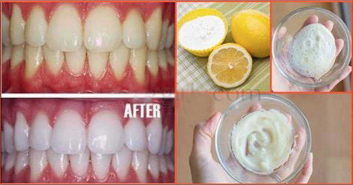 отбеливание лимоном зубов отзывы