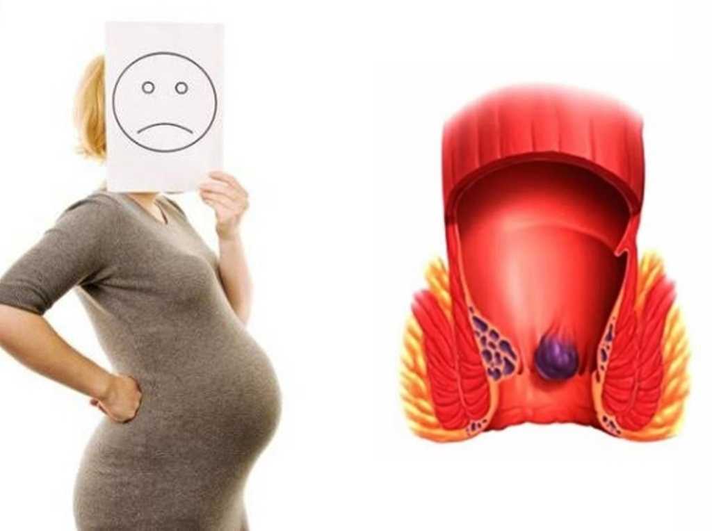 Геморрой при беременности: как быть?