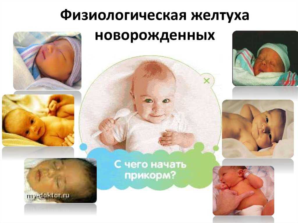 Желтушка у новорождённых: причины, виды, симптомы, лечение, уход
