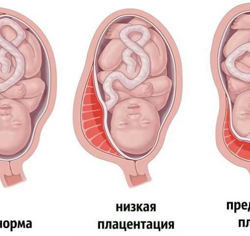 Низкое предлежание плаценты при беременности