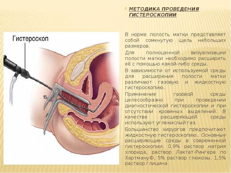 Гистероскопия в гинекологии – описание процедуры и ее проведение