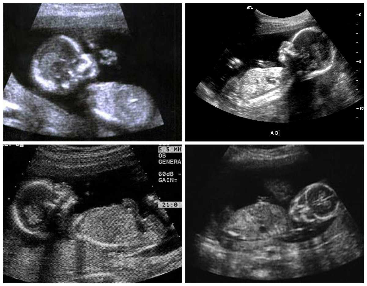 17 неделя беременности: признаки и ощущения женщины, симптомы, развитие плода