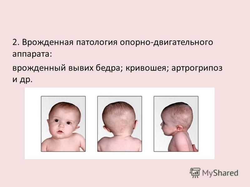 Кривошея у новорожденных: признаки и лечение, причины, симптомы у грудничка в 3 месяца