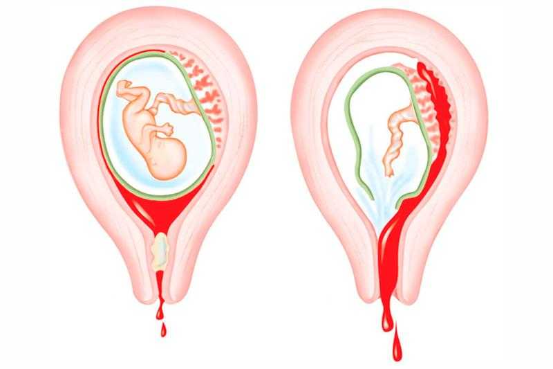 Свечи с папаверином для устранения гипертонуса матки во время беременности