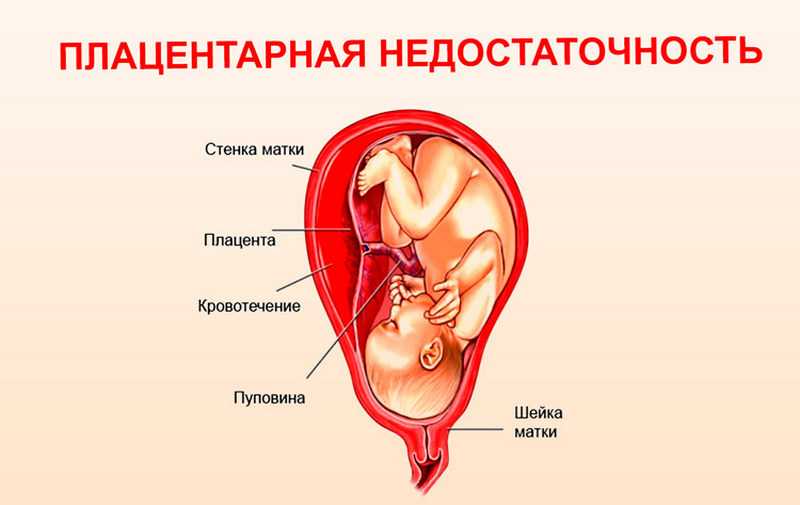 Чем грозит низкое предлежание плаценты при беременности и что нужно сделать чтобы плацента поднялась?