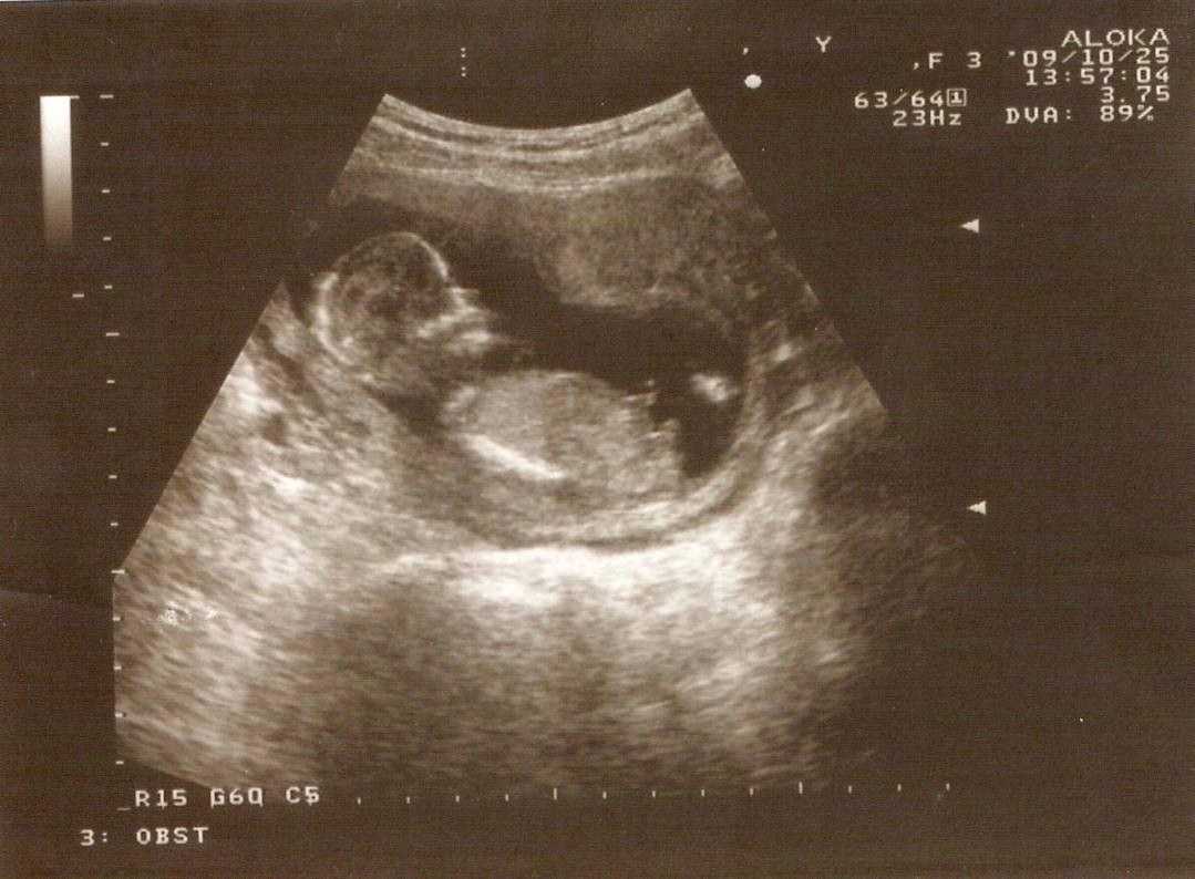 6 неделя беременности – что происходит с малышом, развитие плода (19 фото): размеры ребенка в норме, как выглядит эмбрион