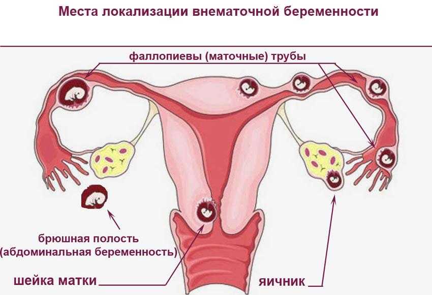 Внематочная беременность: проявления признаков и симптомов, причины на раннем сроке