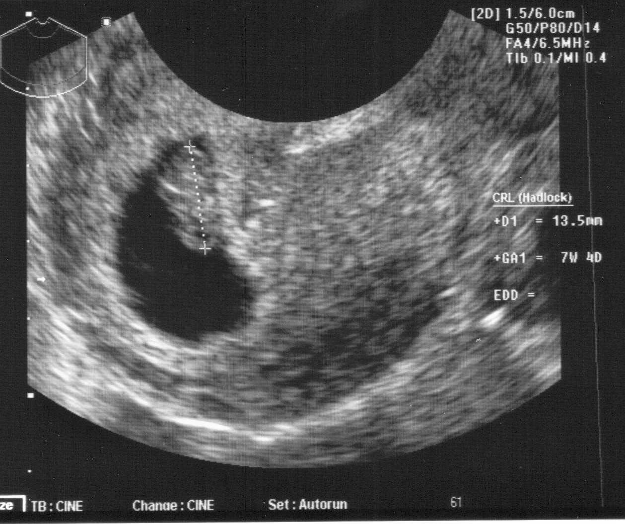 6 неделя беременности (46 фото): что происходит с малышом и мамой на 6 акушерской неделе или 4 от зачатия, симптомы, развитие и ощущения, простуда